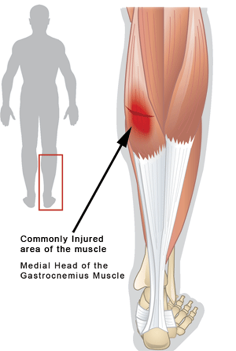 Болит икра на ноге причины и лечение. Надрыв камбаловидной мышцы. Шишка на икроножной мышце. Уплотнение в икроножной мышце. Мышцы икры ног.