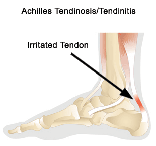Achilles tendon deals painful to touch