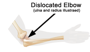 dislocationelbow.gif