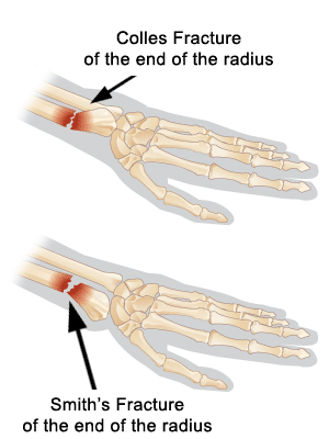 fractures1.gif