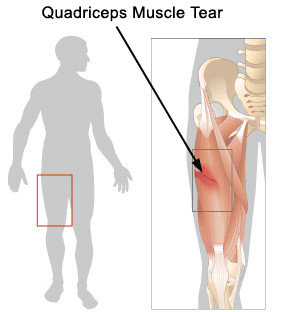 quadracepstrains.gif